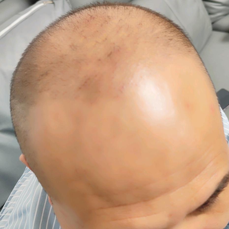 老周的养发记录(徐峰指导)