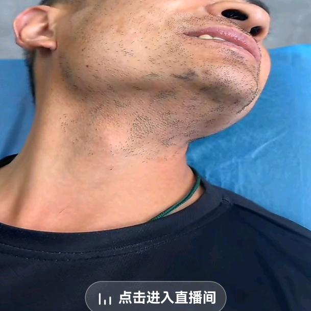 精须堂（永久根除大胡须）