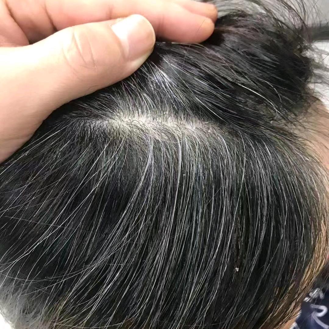 脱发者免费体验1-3个月 签约包效果