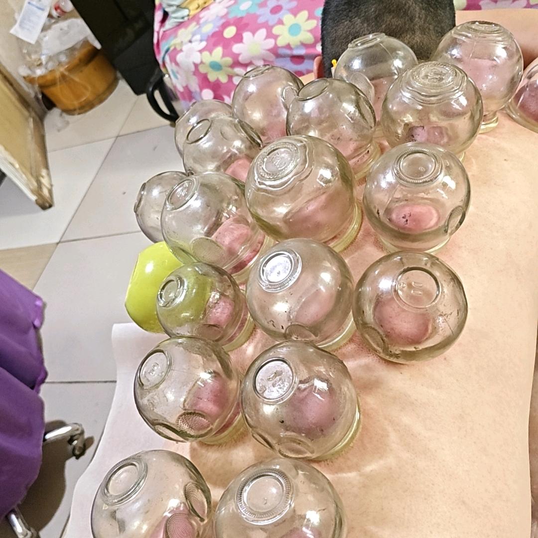 富平张三姐。上门输液。针灸。发烧感冒。