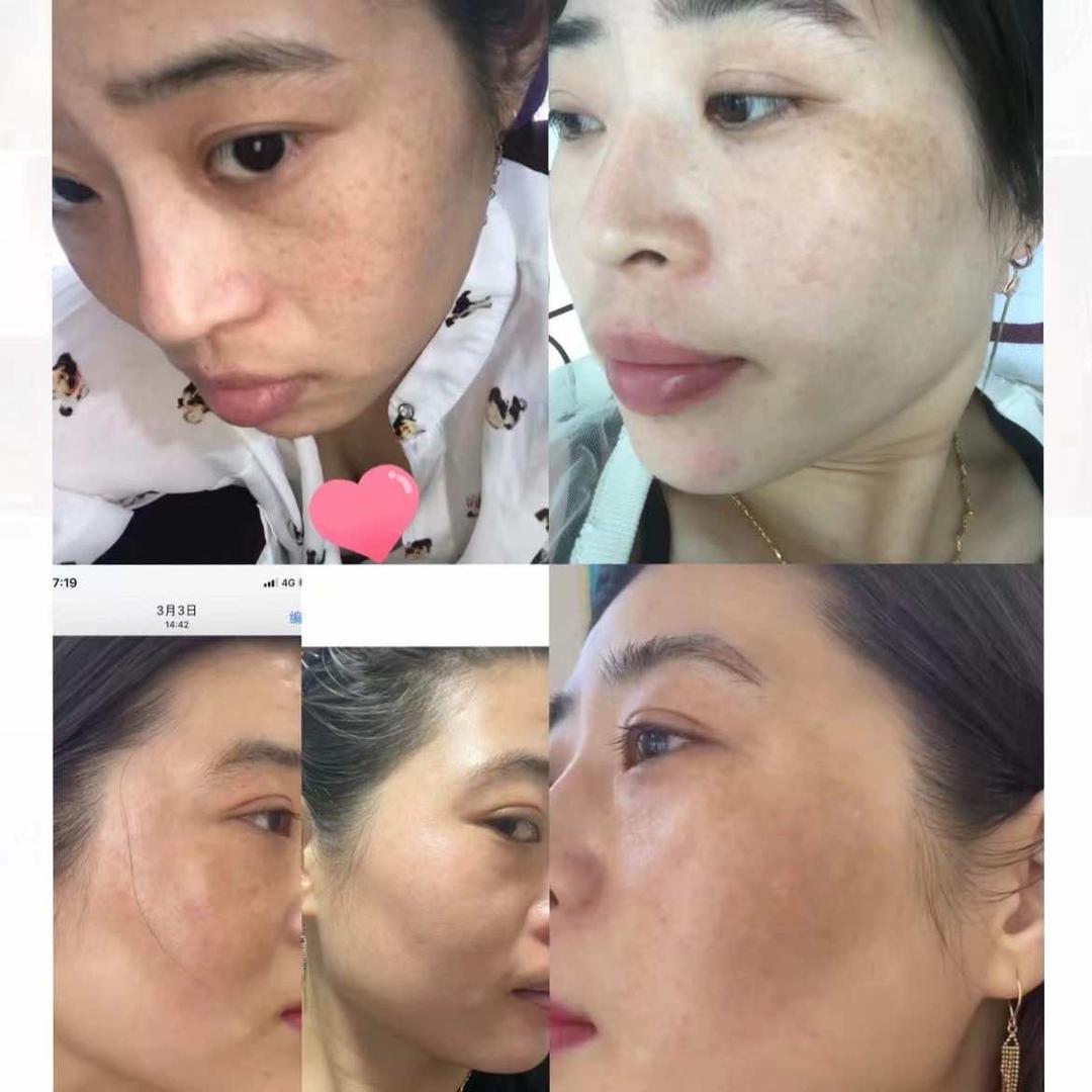 斑痘达人
