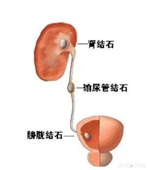 女性输尿管发炎的症状(图1)