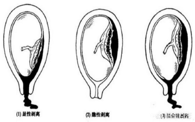 胎盘剥离是什么意思，胎盘早剥有哪些表现症状,第1张