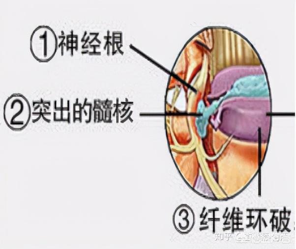 腰酸背痛是什么原因