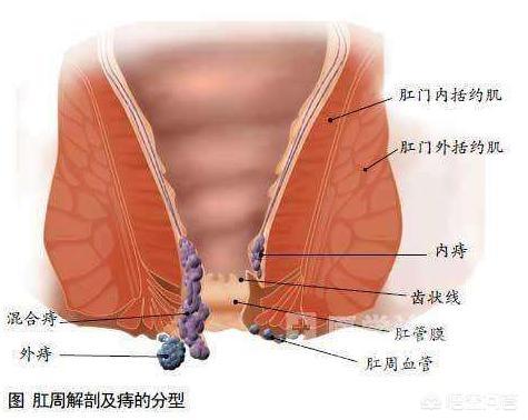 内痔的位置图片