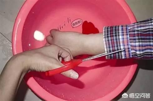 小孩烫伤起泡怎么办 一度二度三度烫伤图片