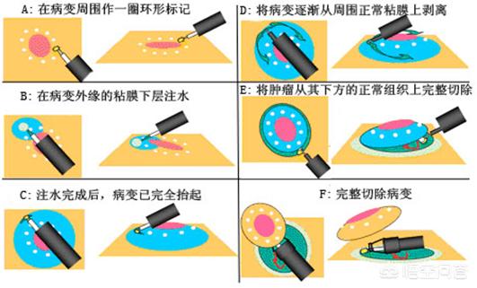 息肉怎么切除和保养(图5)
