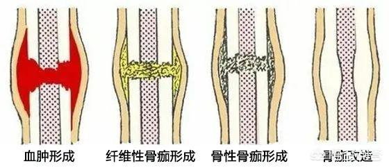 骨折了吃什么(骨折了吃什么钙片好)