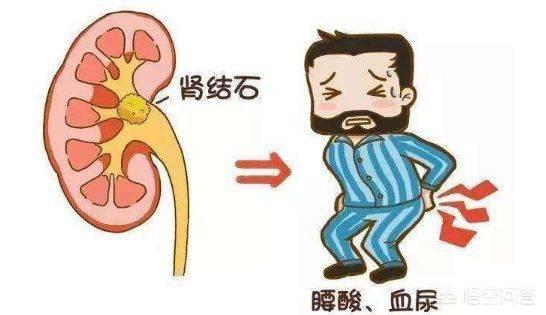 肾结石的症状有哪些症状 女性肾结石一般是哪里疼