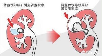 肾结石的症状有哪些症状 女性肾结石一般是哪里疼