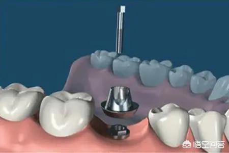 种植牙有几种方法，种植牙有几种方法哪种比较好