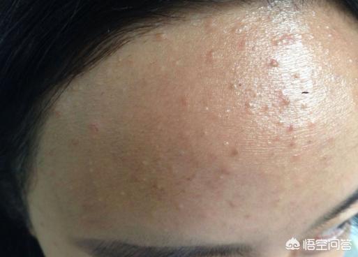 头发出油厉害怎么调理(图1)