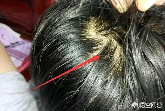 头发出油厉害怎么调理(图2)