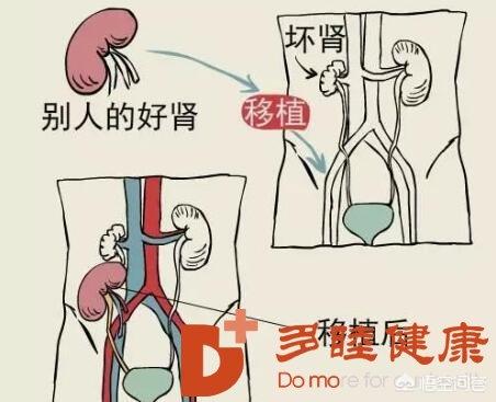 86岁尿毒症晚期还能活多久？：女大学生尿毒症晚期