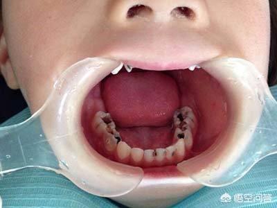 儿童换牙注意什么啊快六岁孩子开始掉牙了，要怎么保护牙齿呢