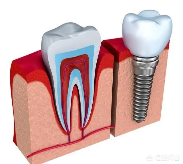 种植牙有几种方法，种植牙有几种方法哪种比较好