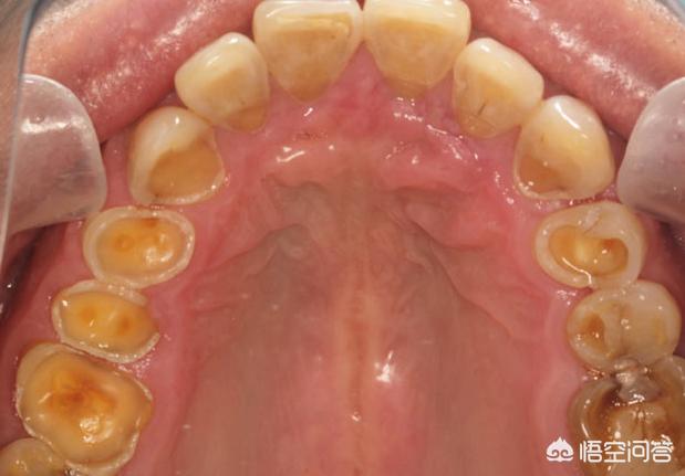 有哪些口腔疾病容易引起牙疼