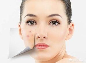 脸上长痘痘怎么去掉痘痘(图33)