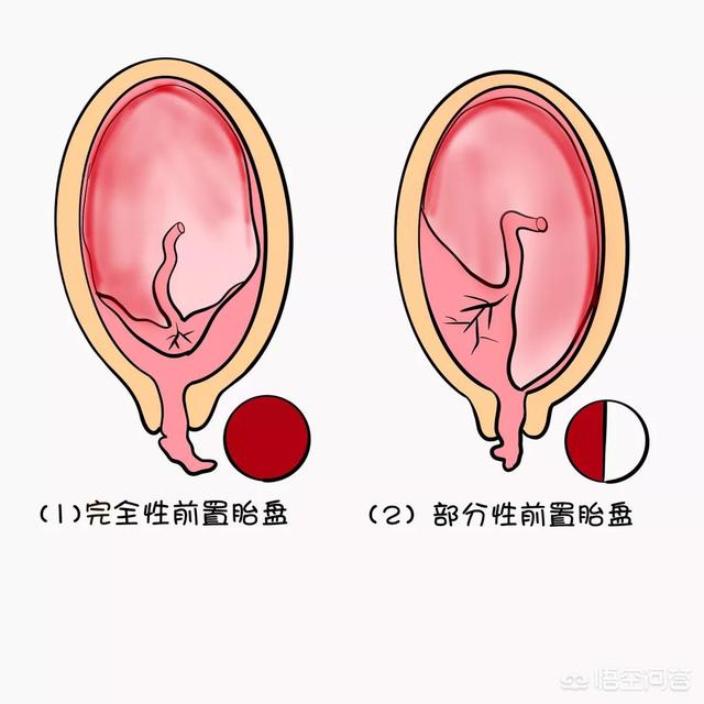 前置胎盘为什么容易留学-前置胎盘，一直流血，有没有危害？