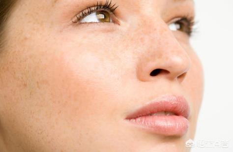 雀斑是什么原因引起的（皮肤长雀斑是什么原因引起的）