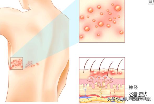 带状疱疹怎么治(带状疱疹怎么治呢)