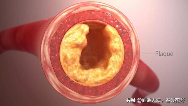 动脉粥样硬化怎么改善(图1)