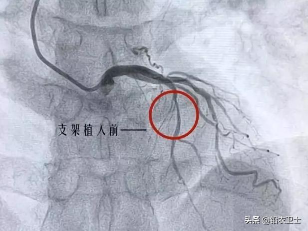 介入手术是什么意思