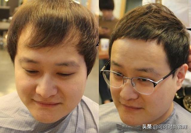 男地中海脱发怎么改善(图1)