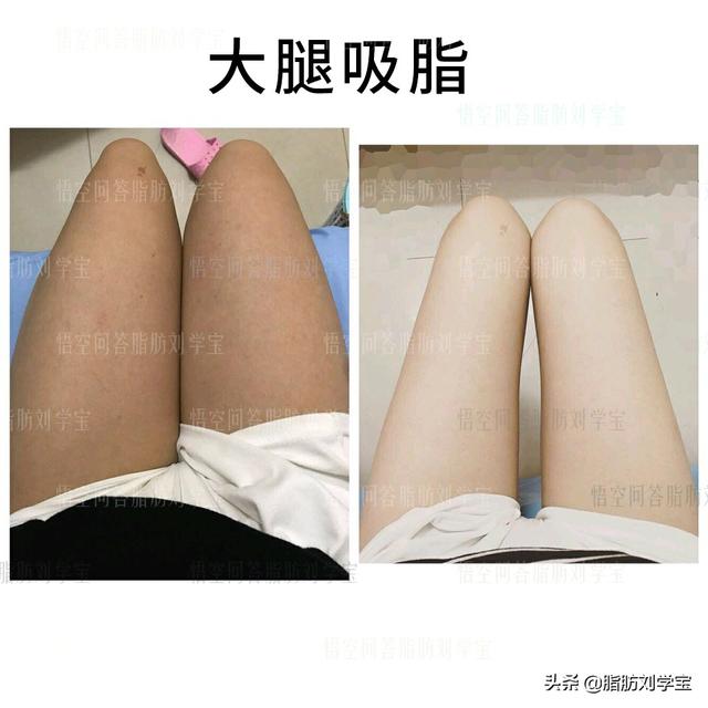吃药，节食，锻炼，哪种减肥方法见效最快