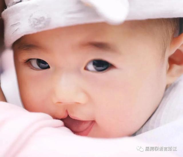 腭裂手术后说话不清楚怎么办(图5)