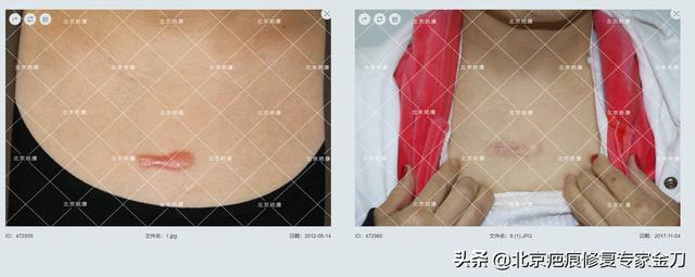 疤痕疙瘩怎么能彻底消除(图2)