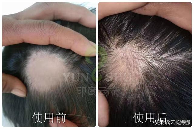掉头发严重怎么改善(图5)