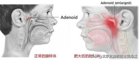 腺样体肥大怎么形成的