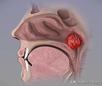 腺样体肥大怎么治(图1)
