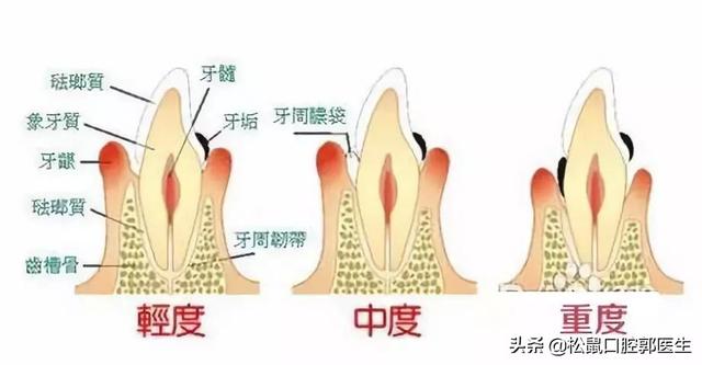 有牙周病怎么改善牙周炎(图1)