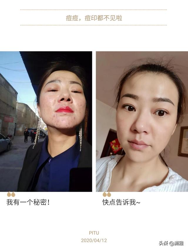 脸上长痘痘怎么去掉痘痘(图34)