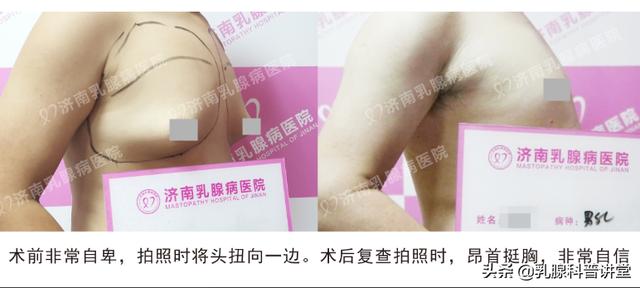 男士乳房大怎么办