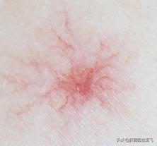 肝功能异常的表现有哪些,第1张