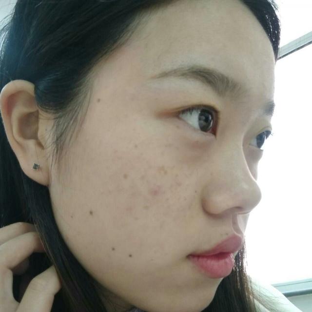 脸上长痘痘怎么去掉痘痘(图18)