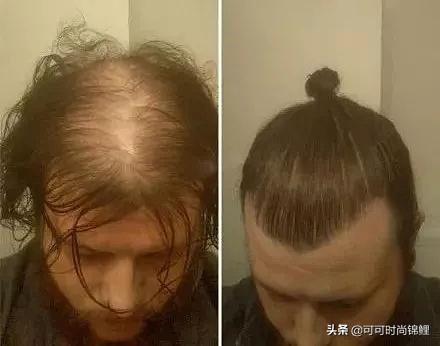 男地中海脱发怎么改善(图2)