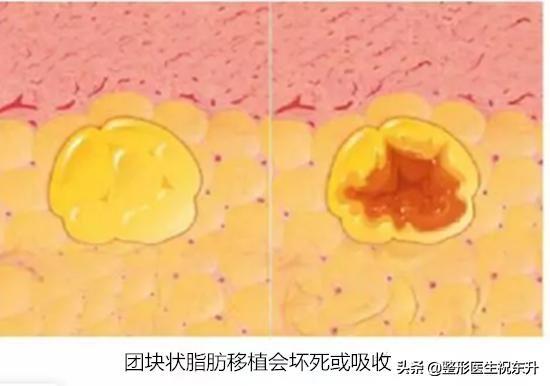 填充脂有什么作用和功效(图10)
