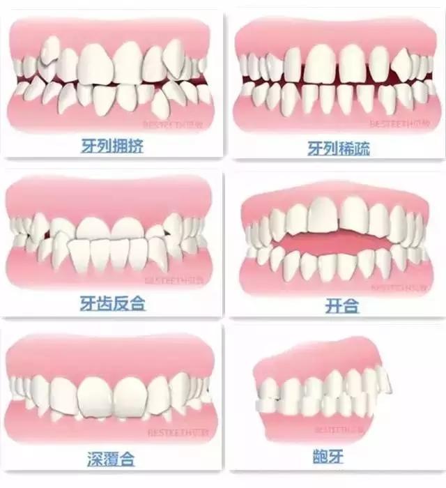 破解牙齿矫正四谣言=-=矫正牙齿的陷阱