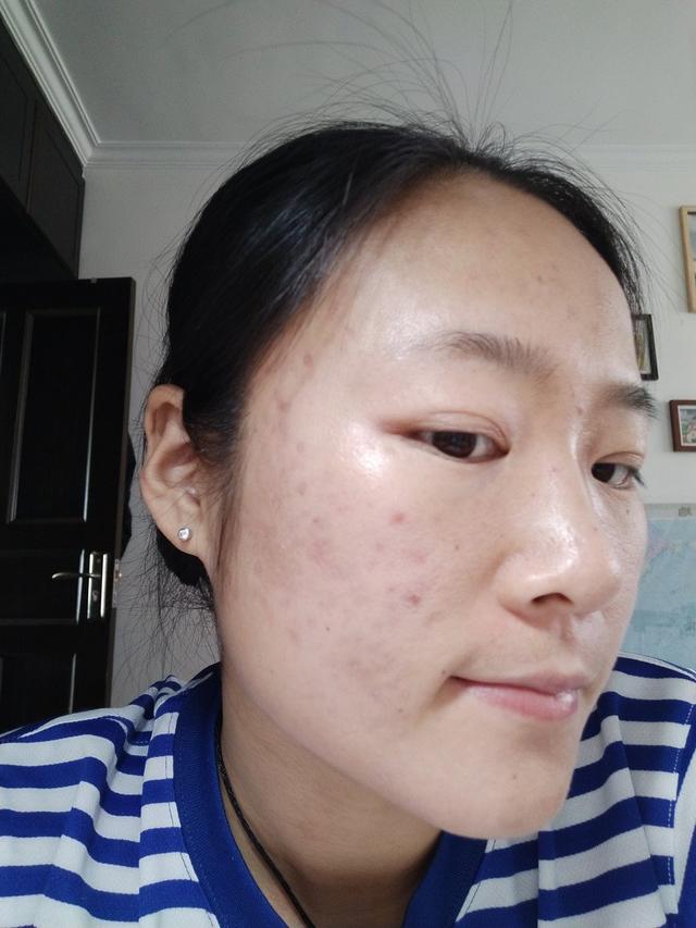脸上长痘痘怎么去掉痘痘(图20)