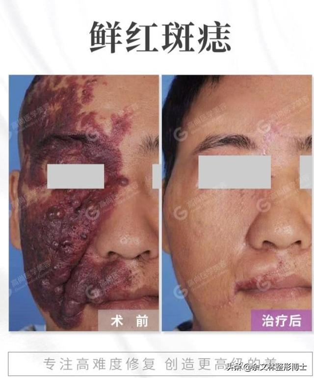 鲜红斑痣怎么治疗(图2)