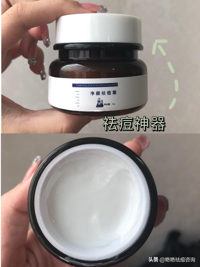 女人下巴长痘痘是什么原因(图1)