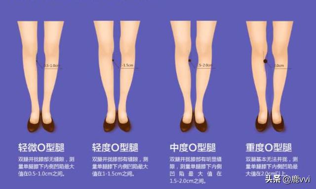 腿的图片（什么是o型腿要图片的？）