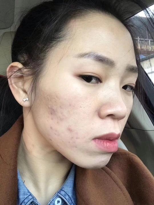 脸上长痘痘怎么去掉痘痘(图19)