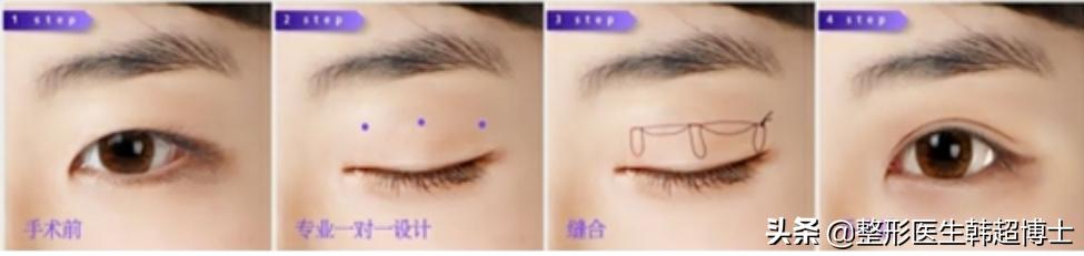 怎么怎么割双眼皮(怎么割双眼皮好看)