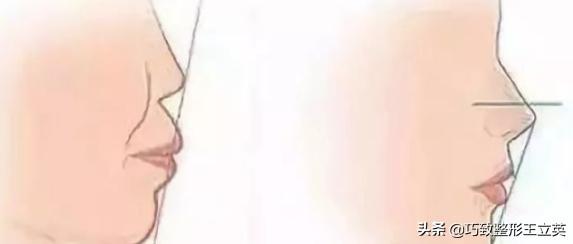 广州鼻基底凹陷怎么改善(图2)