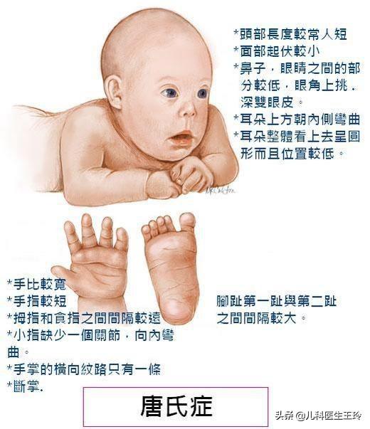 为什么会得唐氏综合症（为什么会出现唐氏综合症）